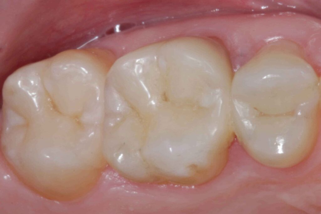 otturazioni dentali costi