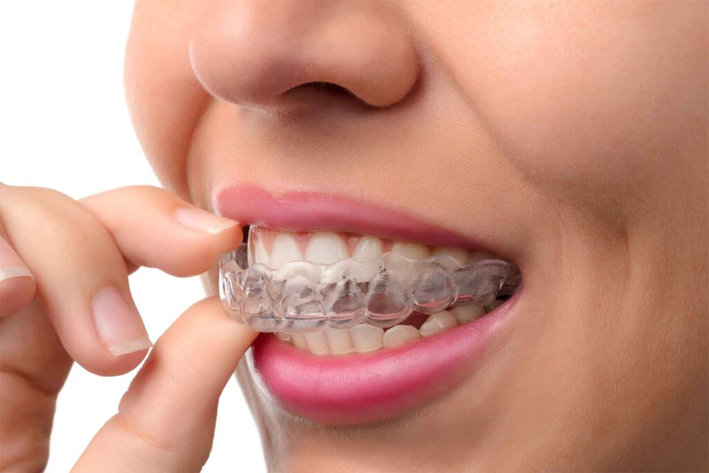 invisalign dopo trattamento