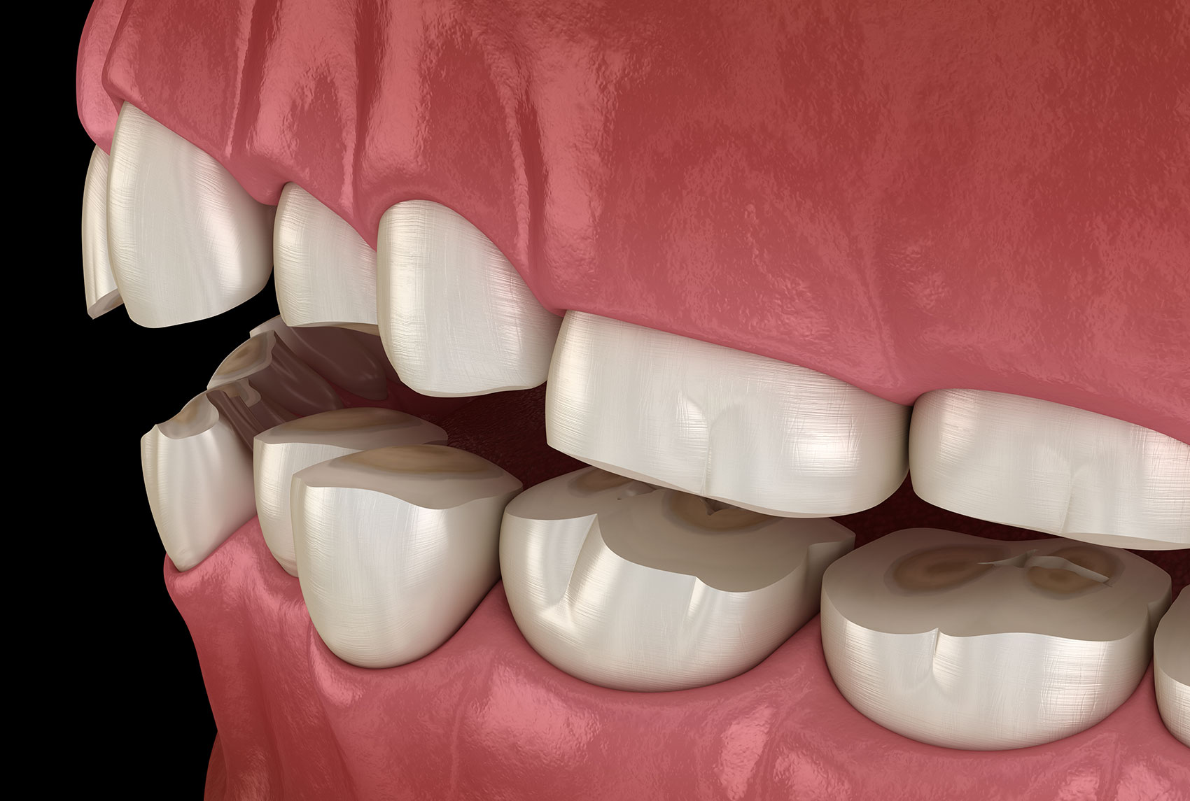 Cause dei denti consumati e ricostruzione - DentistArt Srl