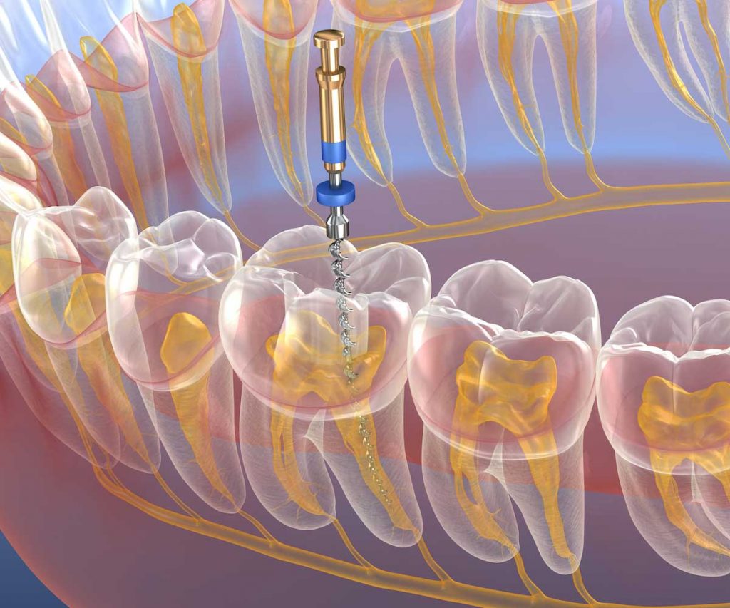 devitalizzazione dente 3 canali