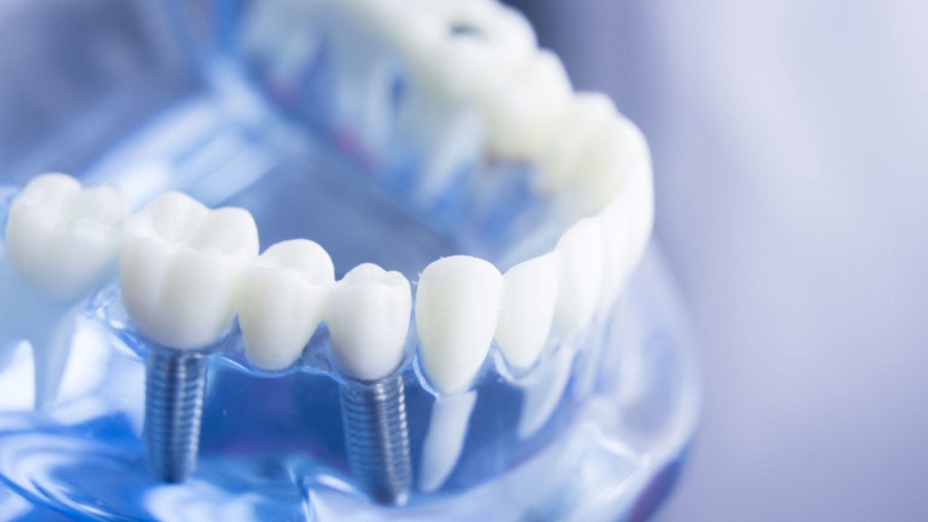 impianto dentale rischi