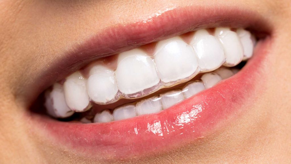 apparecchio invisibile per denti storti