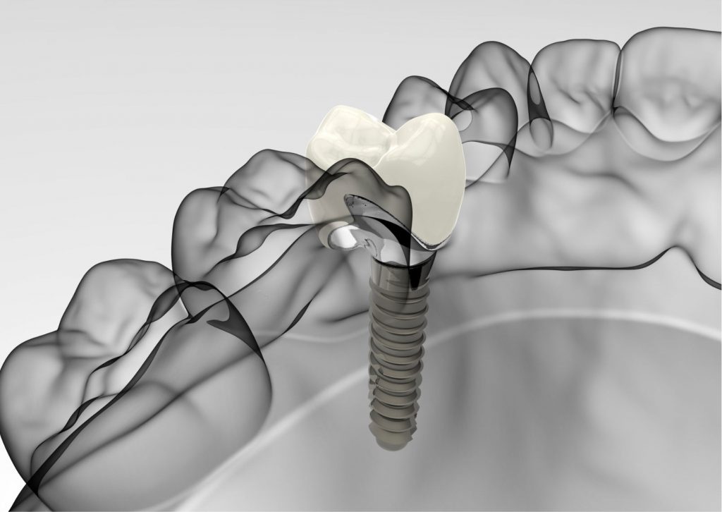 implantologia dentale prezzo