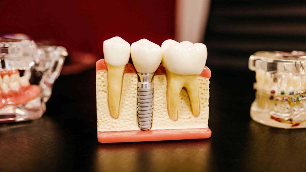 implantologia-denti-roma-prezzo