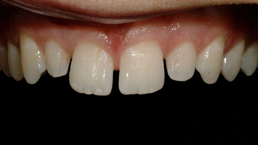 Denti Larghi Davanti