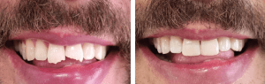 faccette estetiche dentali roma