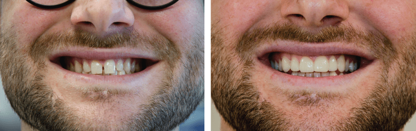 faccette estetiche non invasive