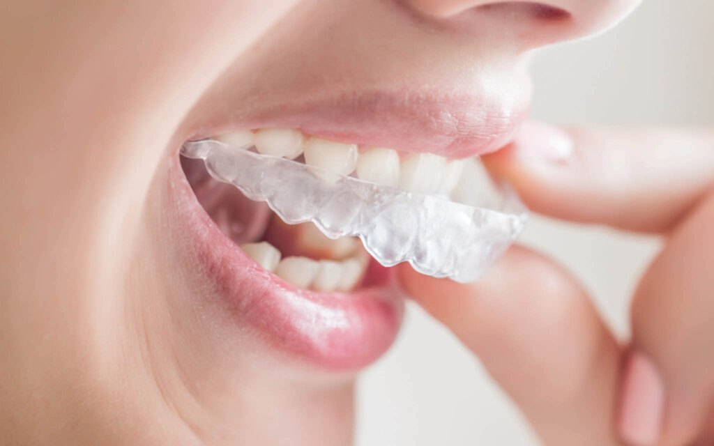 invisalign costo Roma