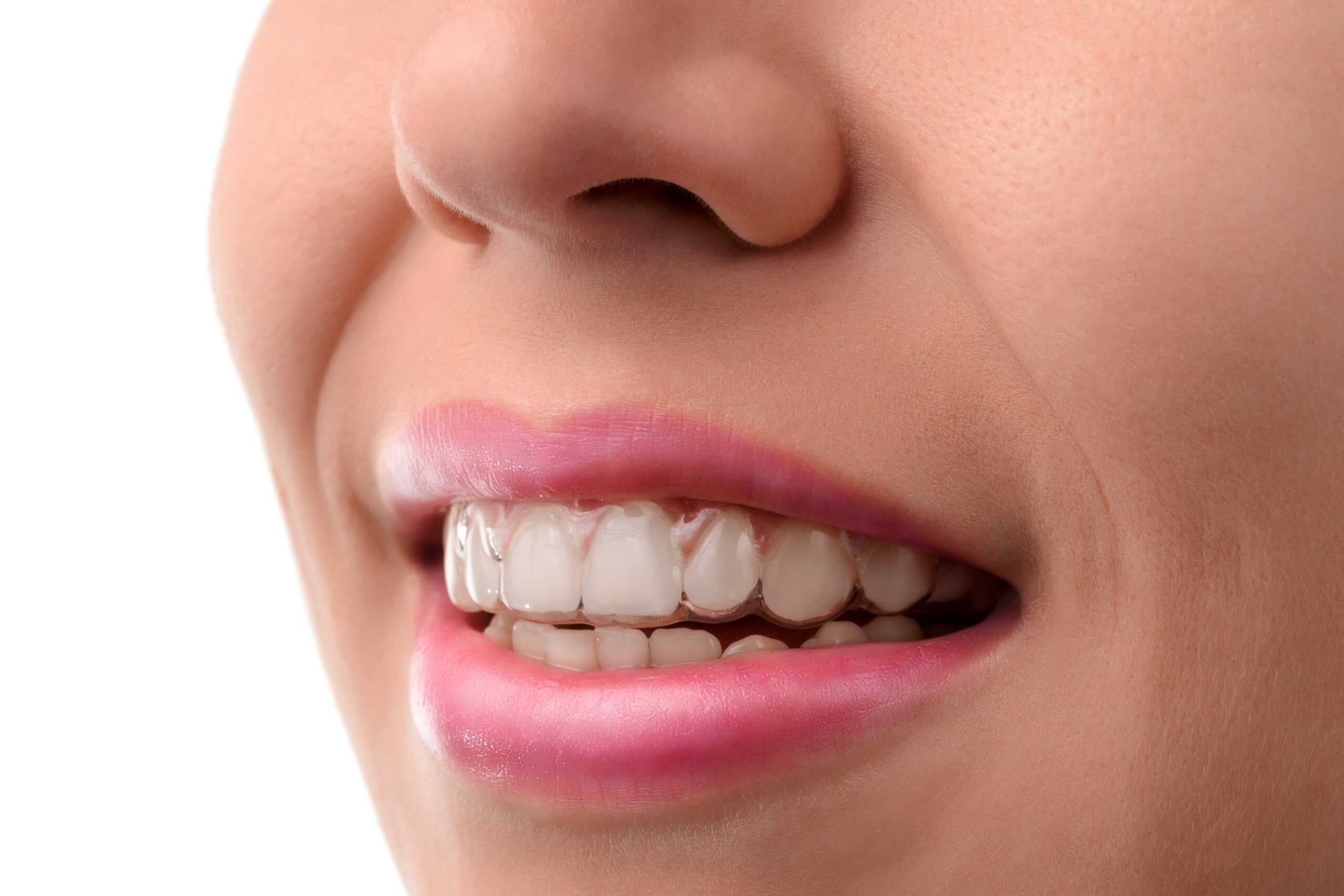 invisalign roma costo