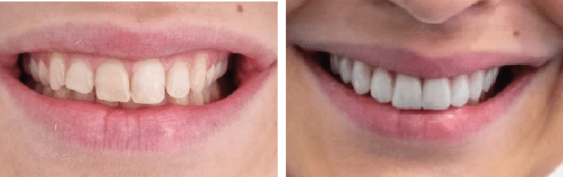 mascherine invisibili roma invisalign