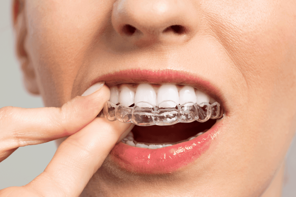 Trattamento Invisalign