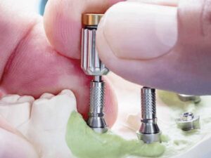 impianti dentali costo roma
